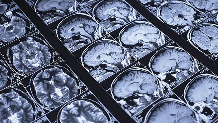 Deaths from dementia are on the rise in Spain