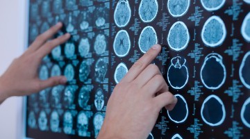 What do Spaniards know about Alzheimer's? The five most widespread false beliefs